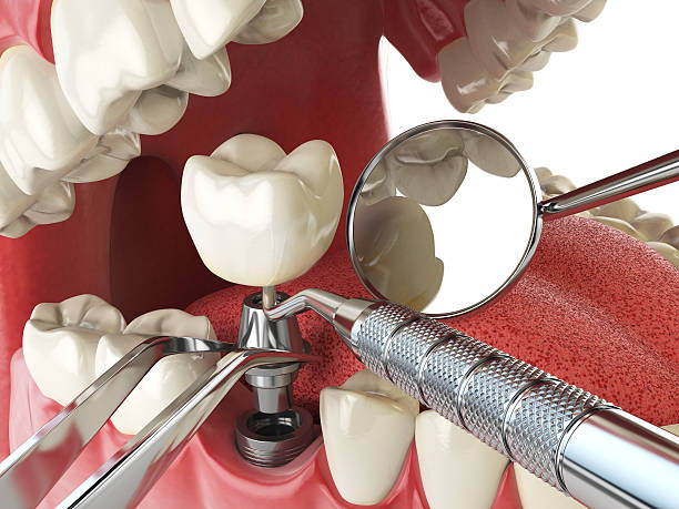 Best Emergency Broken Tooth Repair in Southside Place, TX
